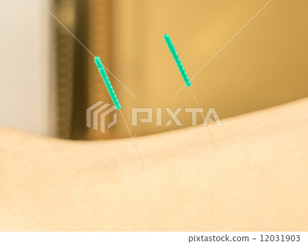 Acupuncture (beam) Acupuncture (beam) 12031903
