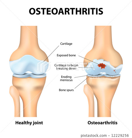 Osteoarthritis or arthritis 12229256