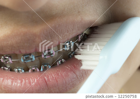 Braces series Braces series 12250758