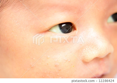 1 month old baby jaundice 12286424