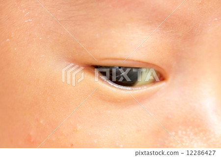 1 month old baby jaundice 12286427