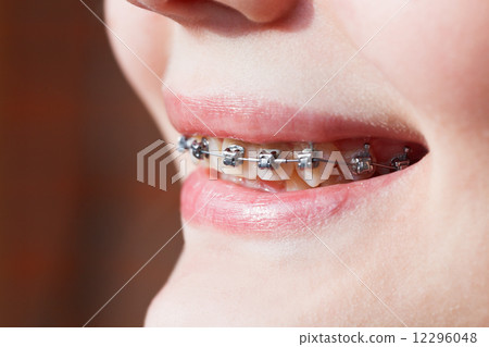 side view of dental braces on teeth 12296048