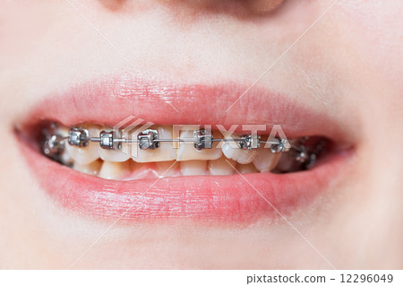 front view of dental braces on teeth of upper jaw 12296049