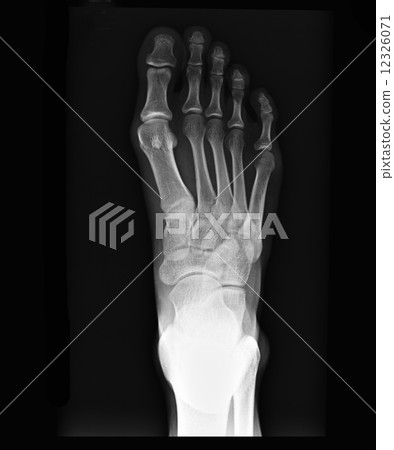 x-ray of foot x-ray of foot 12326071