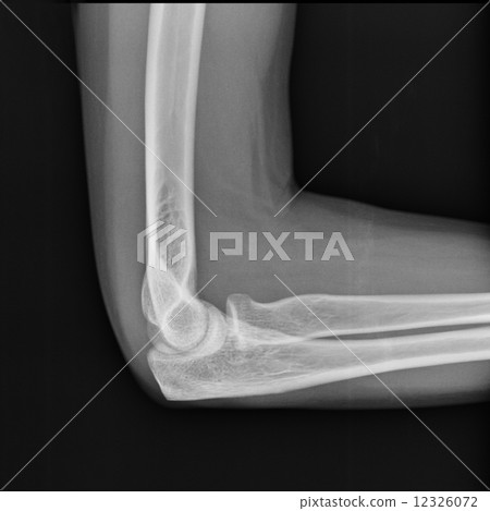 X-ray view of elbow X-ray view of elbow 12326072
