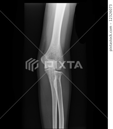 X-ray view of elbow X-ray view of elbow 12326073