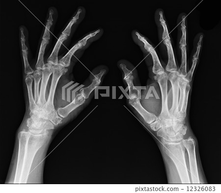 X-ray of hand 12326083