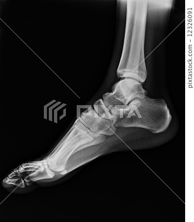 x-ray of foot 12326091
