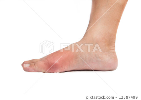 Foot with inflamed gout 12387499