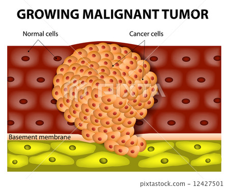 growing malignant tumor growing malignant tumor 12427501