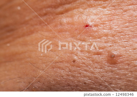 Holes with blood on the face after blackheads extracted 12498346