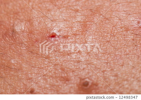 Holes with blood on the face after blackheads extracted 12498347