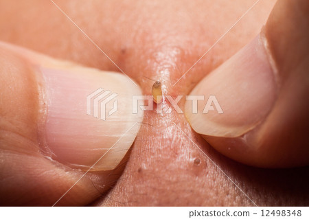 Squeezing blackheads from the forehead using fingernails 12498348