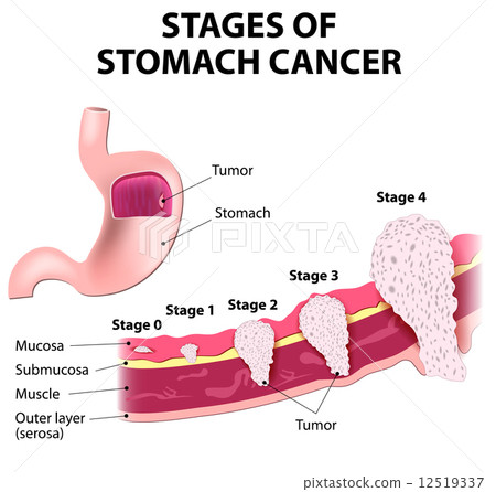 Staging of stomach cancer Staging of stomach cancer 12519337