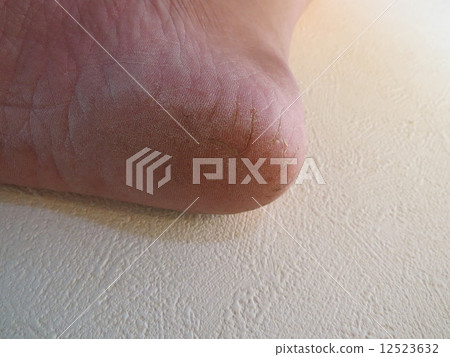 Heel crack Heel crack 12523632