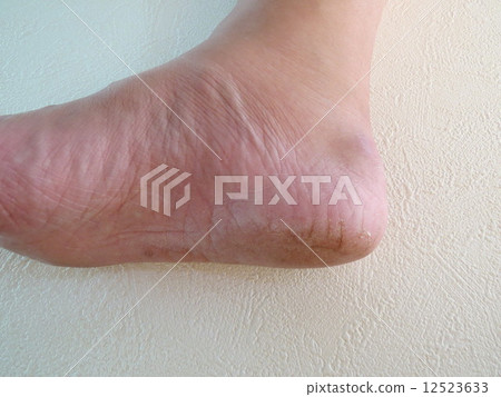 Heel crack Heel crack 12523633