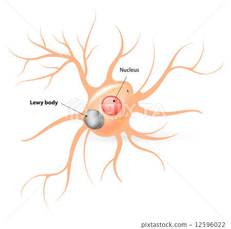 Lewy body. Parkinson's disease and Alzheimer's disease Lewy body. Parkinson's disease and Alzheimer's disease 12596022