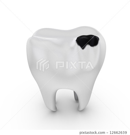 tooth decay 12662639