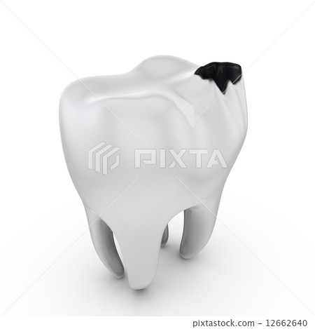 tooth decay tooth decay 12662640