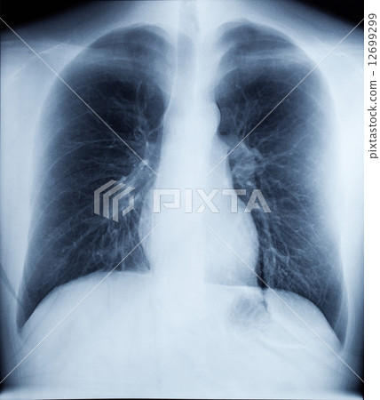 X-Ray Image Of Human Chest 12699299