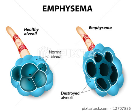 Emphysema Emphysema 12707886