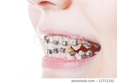 dental steel braces on teeth close up 12731202