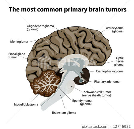 The most common primary brain tumors 12746921