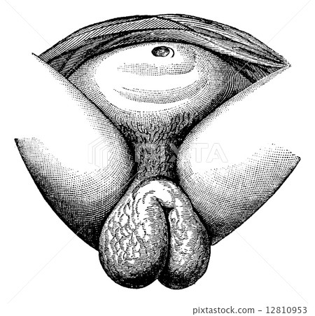 Elephantiasis of the labia majora in women observe a fellah, Cai 12810953