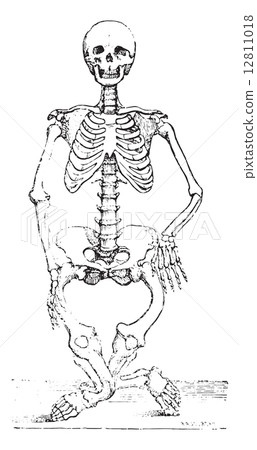 Skeleton deformed by rickets, vintage engraving. 12811018