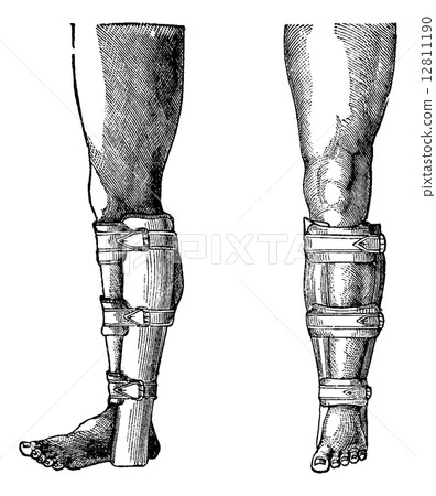 Splint Applied to a Fractured Leg, vintage engraving 12811190