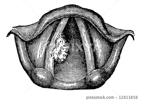 solitary papilloma of larynx