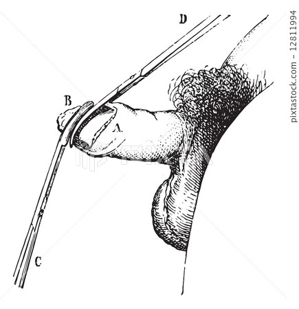 Operation of phimosis by circumcision, vintage engraving. 12811994