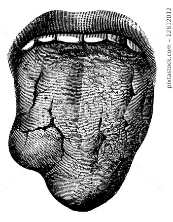 Tumors and Syphilitic Ulcerations of the Human Tongue, vintage e 12812012