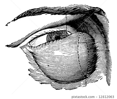 Highly Developed Lacrimal Tumor, vintage engraving 12812063