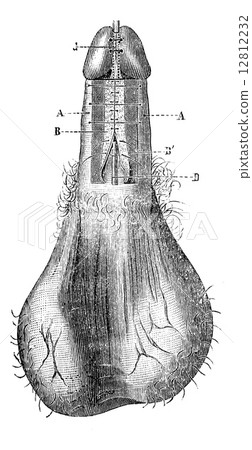 Operation of hypospadias (Process for the Duplay) vintage engrav 12812232