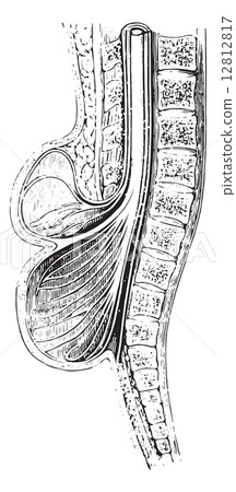 Cup anteroposterior spinal practiced on a spina bifida, vintage 12812817