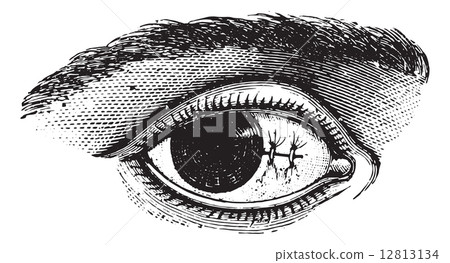 Suture of the conjunctiva after excision of pterygium, vintage e 12813134