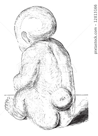 Spina bifida, vintage engraving. Spina bifida, vintage engraving. 12813166