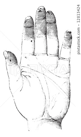 Sclerosis or Sclerotizis of the left hand (palmar surface), vint Sclerosis or Sclerotizis of the left hand (palmar surface), vint 12813424