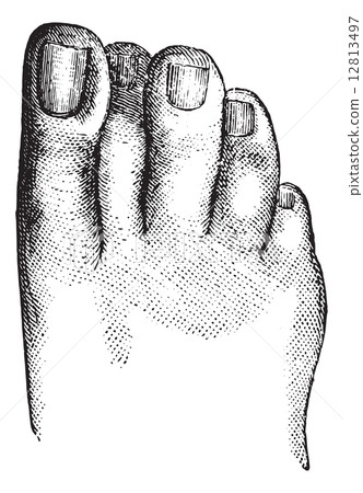 Faulty position of the second toe, vintage engraving. 12813497