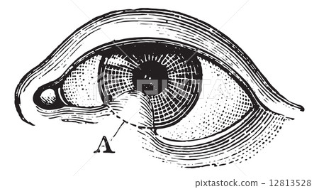 Symblepharon of the lower eyelid, vintage engraving. 12813528