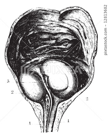 Enlarged prostate or Benign prostatic hyperplasia (BPH), determi 12813682