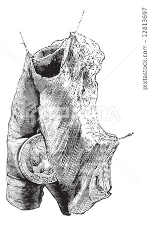 Foreign body in the esophagus, vintage engraving. 12813697