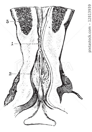 Narrowing of the membranous area of the urethra with dilatation 12813939