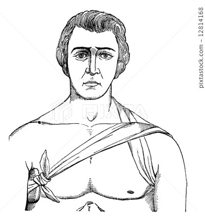 Bandage tie the axillary fold, vintage engraving. Bandage tie the axillary fold, vintage engraving. 12814168