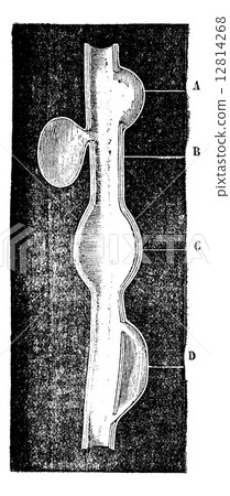 A crateriform aneurysm. B. Saccular aneurysm. C. Fusiform aneur 12814268