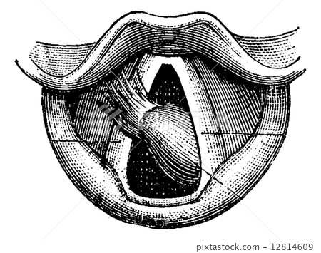 Fibroma of the Larynx, vintage engraving 12814609