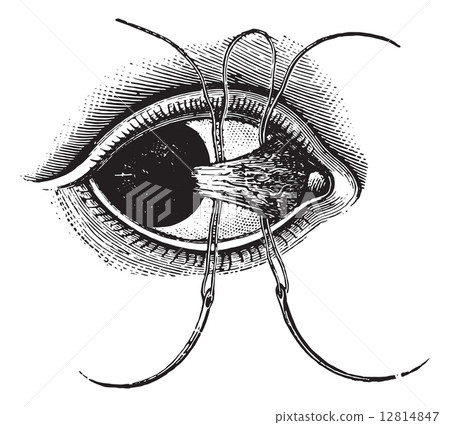 Ligation of pterygium, vintage engraving. 12814847