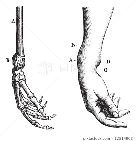 Fracture of the lower extremity of the radius, vintage engraving 12814908