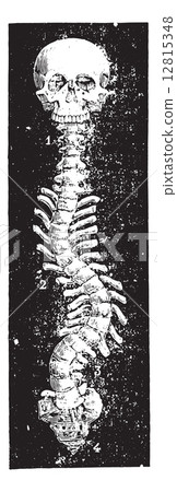 Scoliosis, vintage engraving. Scoliosis, vintage engraving. 12815348